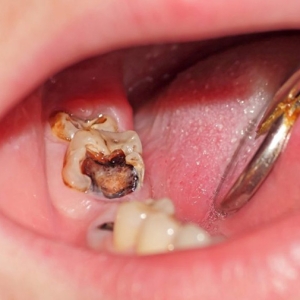 10-cach-tri-sau-rang-vinh-vien-tai-nha