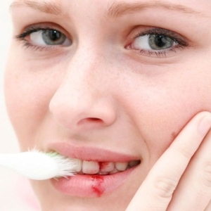 nuot-phai-mau-sau-khi-nho-rang-co-sao-khong