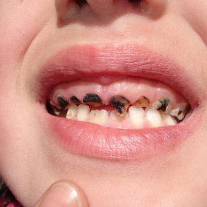 sau-rang-va-cach-phong-ngua-hieu-qua-giai-phap-bao-ve-nu-cuoi-cung-nha-khoa-viet-nha